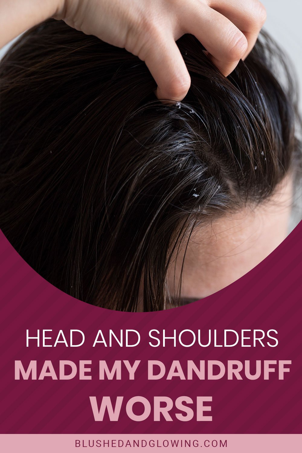 Dandruff on woman's head exposed by combing with fingers - Head And Shoulders Made My Dandruff Worse